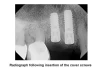 Bone Level-BL B2 (3.1) - 2