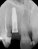 Tapered Internal Plus (3.5) - 5