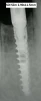 SDI Slim Spiral Implant (2.9) - 3