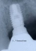 Full OSSEOTITE Parallel Walled (4.1) - 3