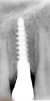 StableDent Post Implant - 5