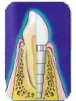 Frialit-2 Stepped Cylinder (3.4) - 3
