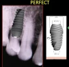 Perfect Titanium Implant (PFTI) 2.43 - 3