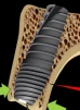 Perfect Titanium Implant (PFTI) 2.43 - 4