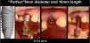 Perfect Titanium Implant (PFTI) 2.43 - 6