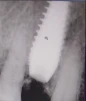 Perfect Titanium Implant (PFTI) 2.43 - 2