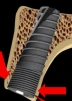 Unique Titanium Implant (UTI) 2.43 - 6