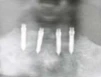 Mini Implant - 4