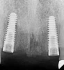 Inclusive Tapered (3.5) - 2