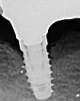 Full OSSEOTITE Tapered Certain (4.1) - 2