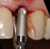 External Hex Conic 4.3 - 4