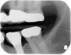 Sustain Cylinder External Hex SD (3.3) - 4