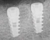Paltop Active Implant PAI TC np - 2