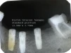 BioCom Internal hexagon-standard platform (3.75) - 3