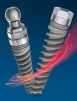 UNO Narrow Implant - 2