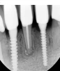 S-Mini Cemented Type - 6