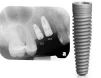 Nobel Replace -Taper NP (3.5) - 3
