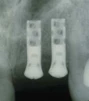 Hollow Cylinder Esthetic Plus 3.5 (4.8) - 4