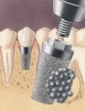 Endopore External Hex (3.5) - 3