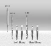 Tidal Ball Implant (TSB) - 3