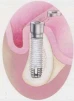 Taper-Lock Screw (4.1) (Paragon) - 2