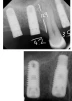 Tapered Screw Vent (3.5) - 7