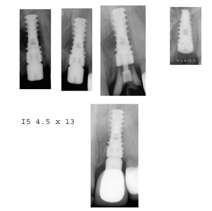 I5 Wide Platform (4.5)