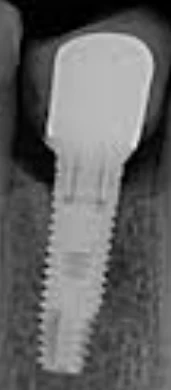 DFI