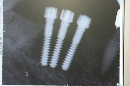 Dental Implant N