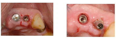 CIH Hexagonal Internal (5.0)