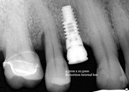 Internal (4.5)