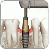 Tapered Internal (3.5)