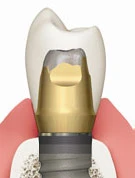 Tapered Internal (3.5)