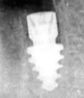 Grip (3.5)