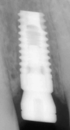 Internal Hex (4.5)