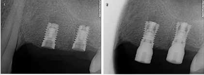 Quad Internal Hex