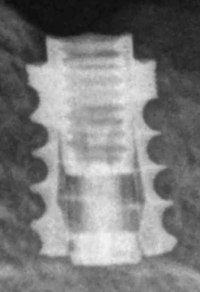 Quad External Hex