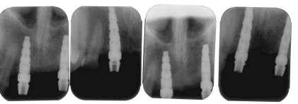 Frialit-2 (5.5)