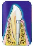 Frialit-2 Stepped Cylinder (3.4)