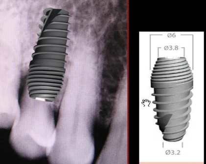 Perfect Titanium Implant (PFTI) 2.43