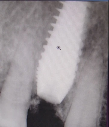 Perfect Titanium Implant (PFTI) 2.43