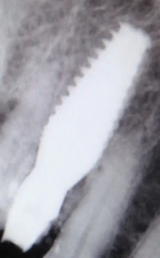 Perfect Titanium Implant (PFTI) 2.43