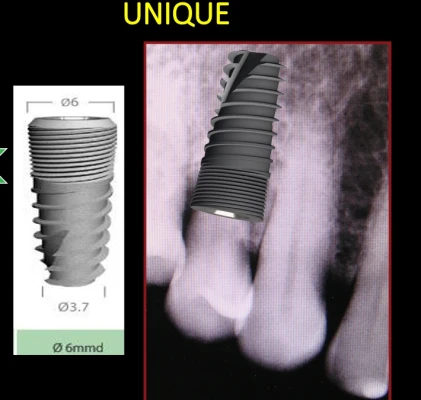 Unique Titanium Implant (UTI) 2.43