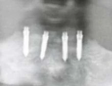 Mini Implant