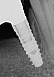 NanoTite Tapered Certain (3.4)