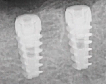 Paltop Active Implant PAI sp