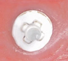 internal 4 interlocks, bolt it tube, wide platform (Keystone, Zeramex XT)