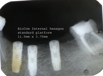 BioCom Internal hexagon-standard platform (3.75)