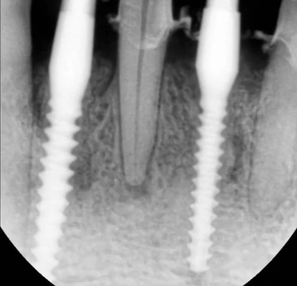 S-Mini Cemented Type