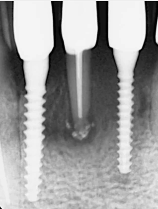 S-Mini Cemented Type